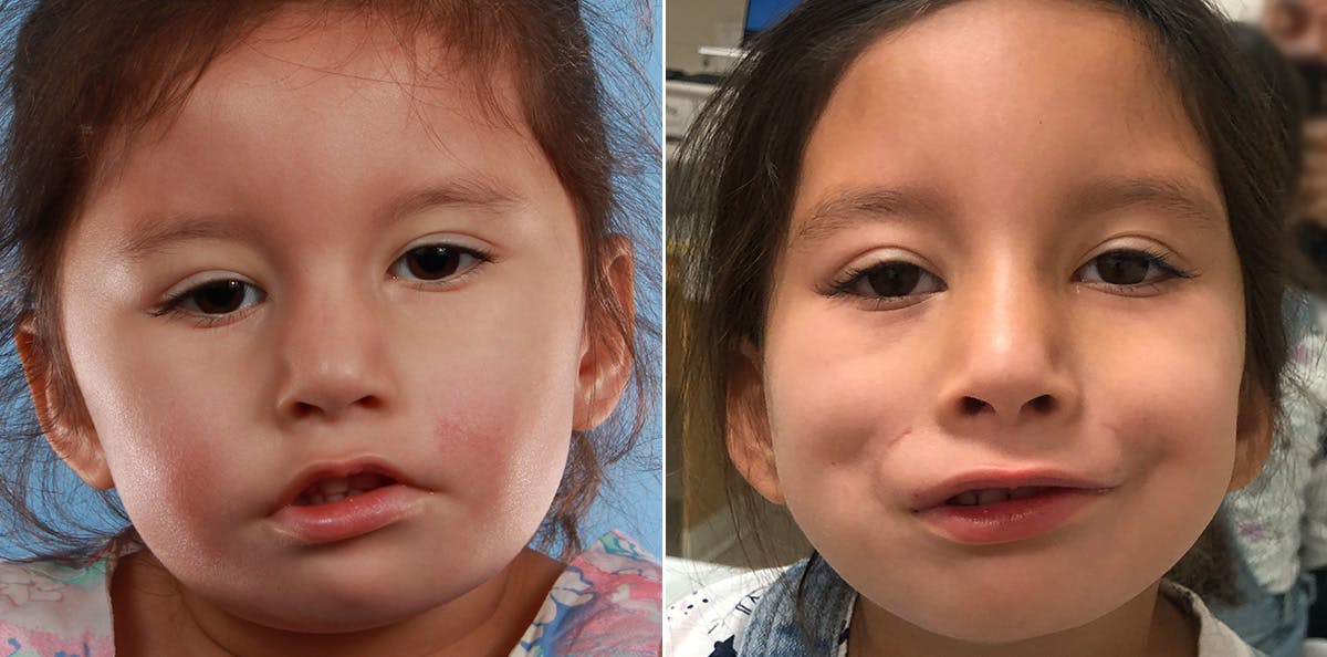 Smile Reanimation Before & After Gallery - Patient 153981 - Image 2