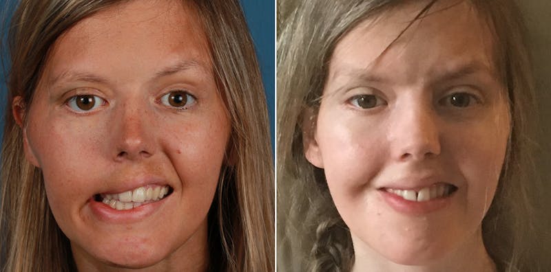 Smile Reanimation Before & After Gallery - Patient 458487 - Image 1
