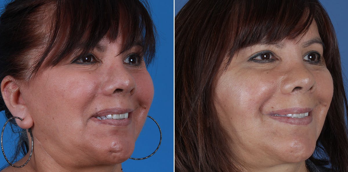 Smile Reanimation Before & After Gallery - Patient 844447 - Image 3