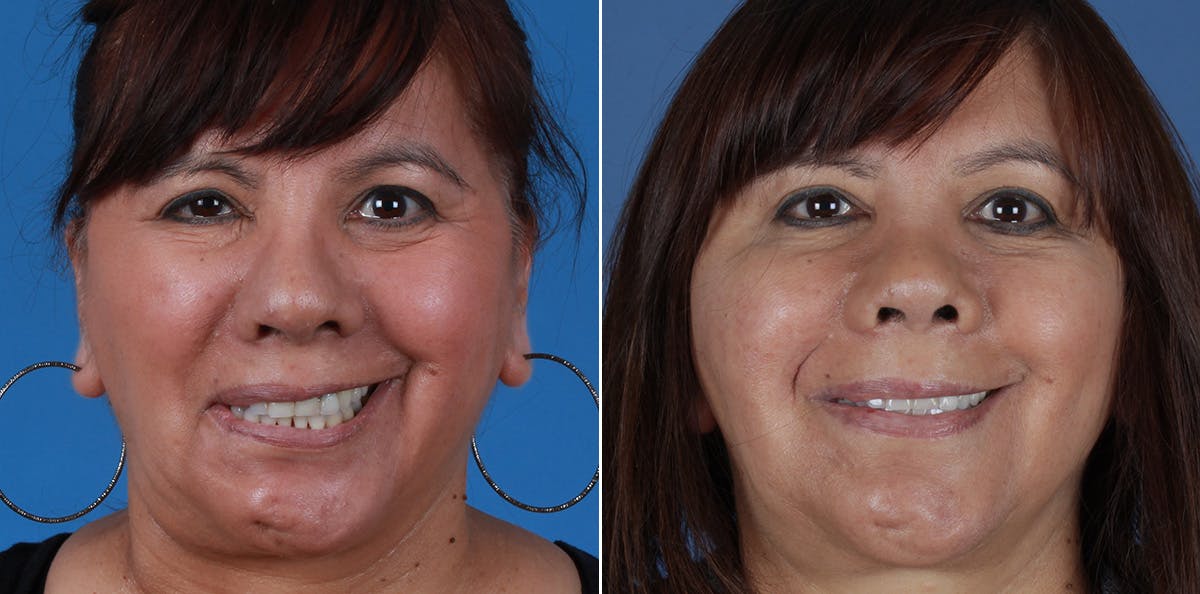 Smile Reanimation Before & After Gallery - Patient 844447 - Image 2