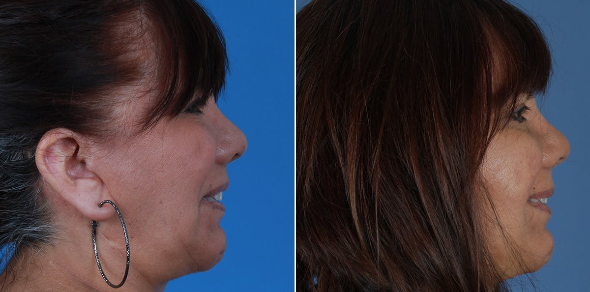 Smile Reanimation Before & After Gallery - Patient 844447 - Image 4