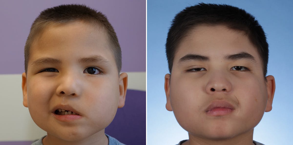 Smile Reanimation Before & After Gallery - Patient 174583 - Image 2