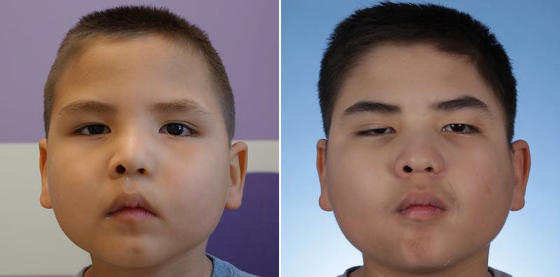 Smile Reanimation Before & After Gallery - Patient 174583 - Image 1