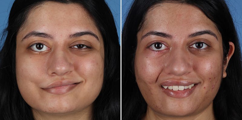 Smile Reanimation Before & After Gallery - Patient 314419 - Image 1