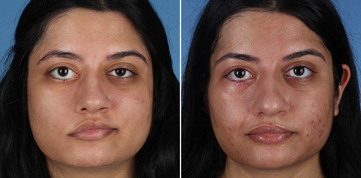 Smile Reanimation Before & After Gallery - Patient 314419 - Image 2