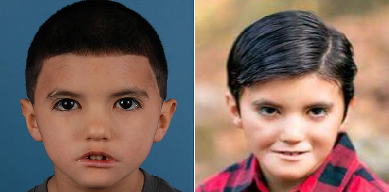 Smile Reanimation Before & After Gallery - Patient 615951 - Image 1