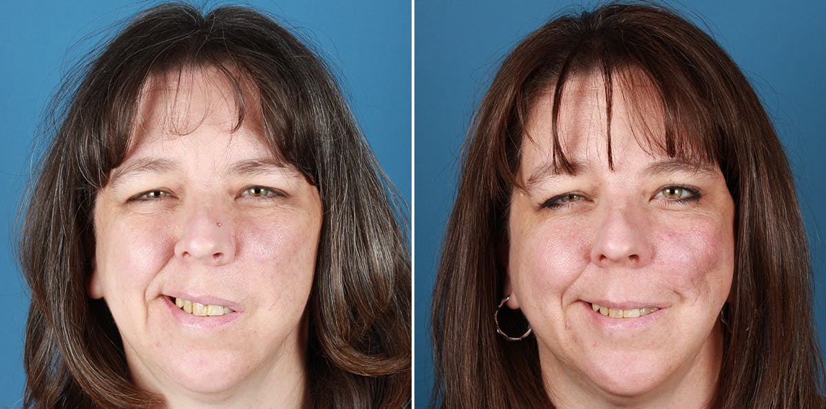Smile Reanimation Before & After Gallery - Patient 571869 - Image 1