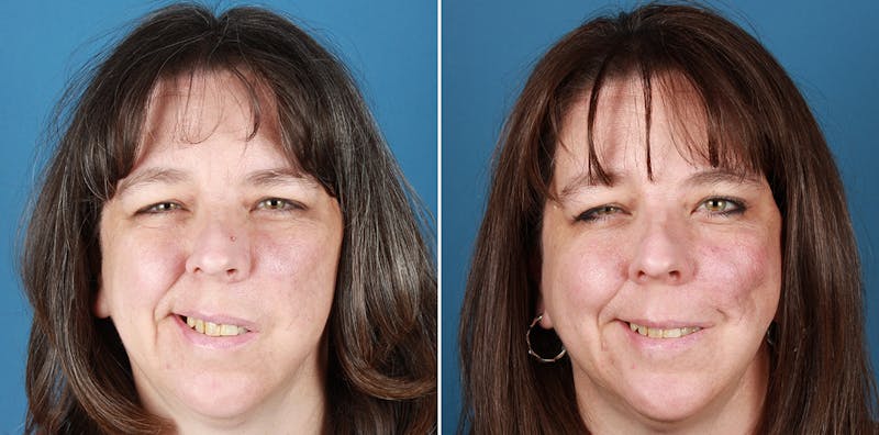 Smile Reanimation Before & After Gallery - Patient 571869 - Image 1