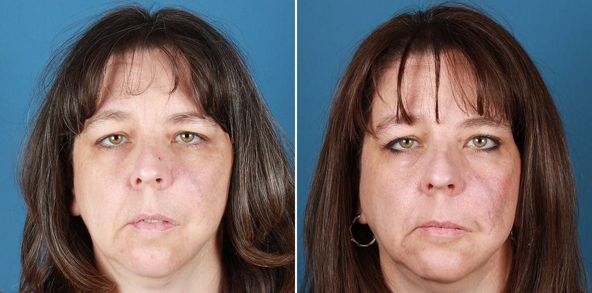 Smile Reanimation Before & After Gallery - Patient 571869 - Image 2