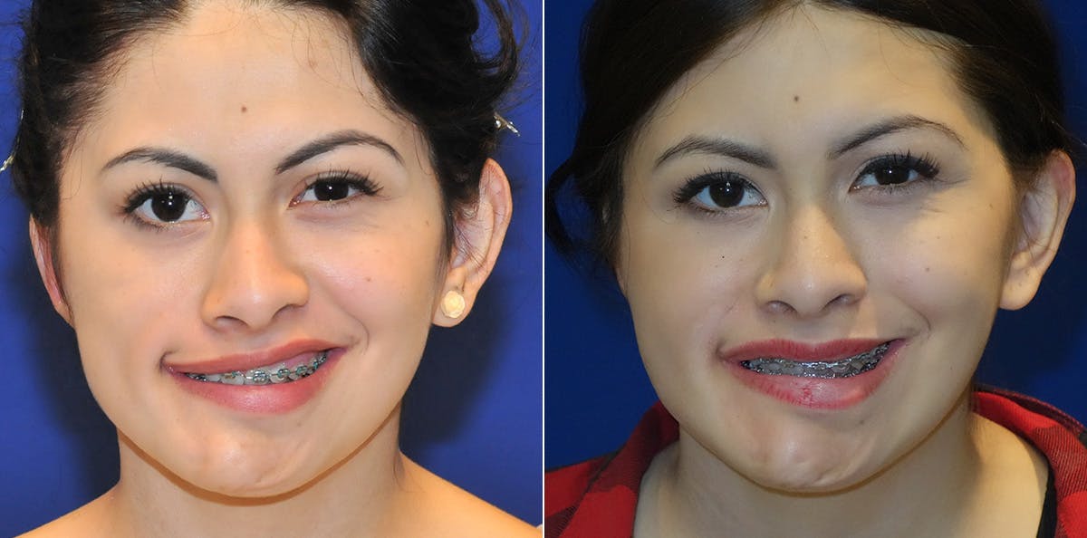Smile Reanimation Before & After Gallery - Patient 144170 - Image 2