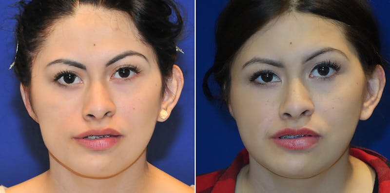 Smile Reanimation Before & After Gallery - Patient 144170 - Image 1