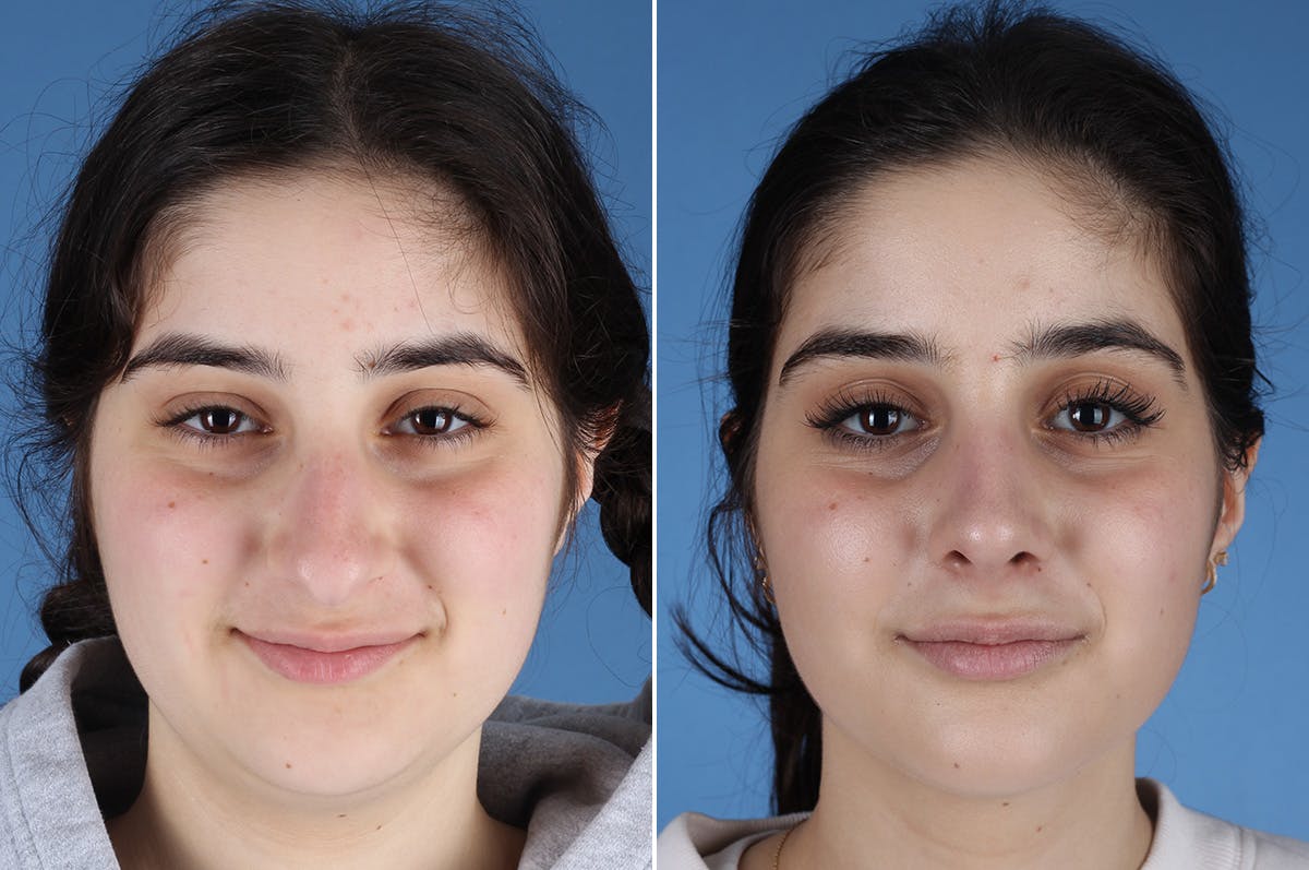 Rhinoplasty Before & After Gallery - Patient 904167 - Image 2