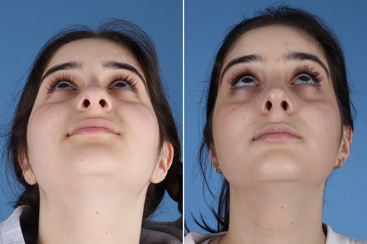 Rhinoplasty Before & After Gallery - Patient 904167 - Image 3