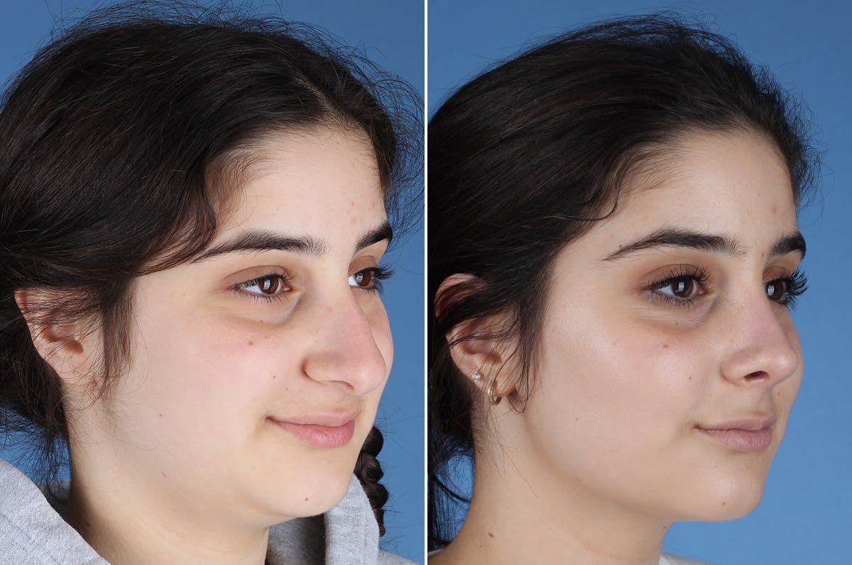 Rhinoplasty Before & After Gallery - Patient 904167 - Image 4