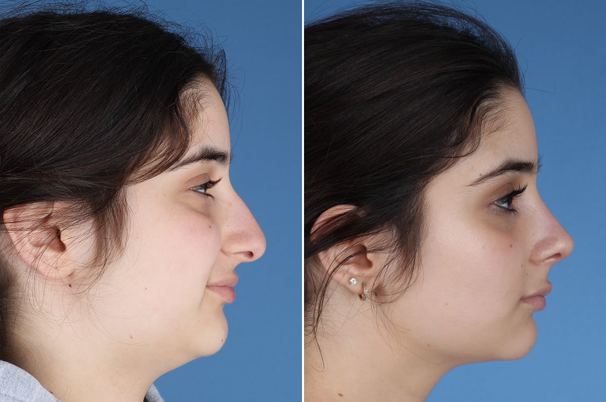 Rhinoplasty Before & After Gallery - Patient 904167 - Image 1