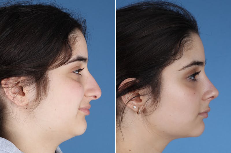Rhinoplasty Before & After Gallery - Patient 904167 - Image 1