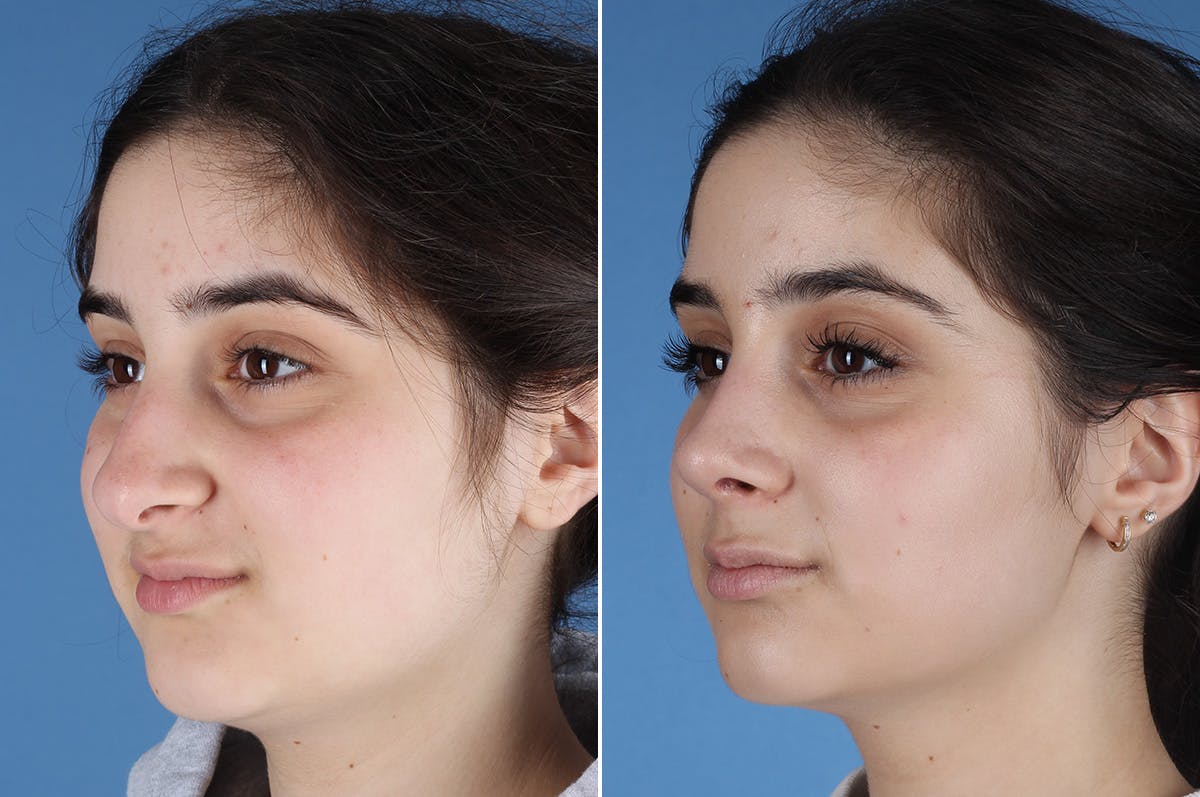 Rhinoplasty Before & After Gallery - Patient 904167 - Image 5