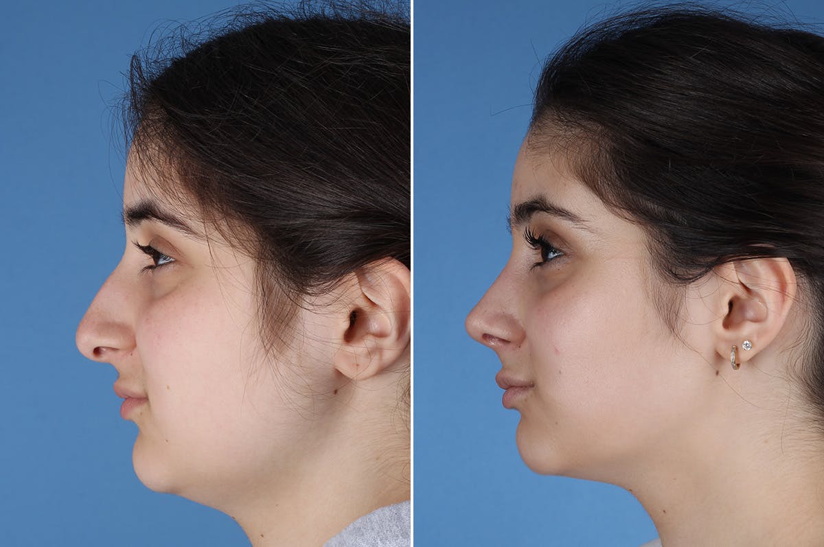 Rhinoplasty Before & After Gallery - Patient 904167 - Image 6