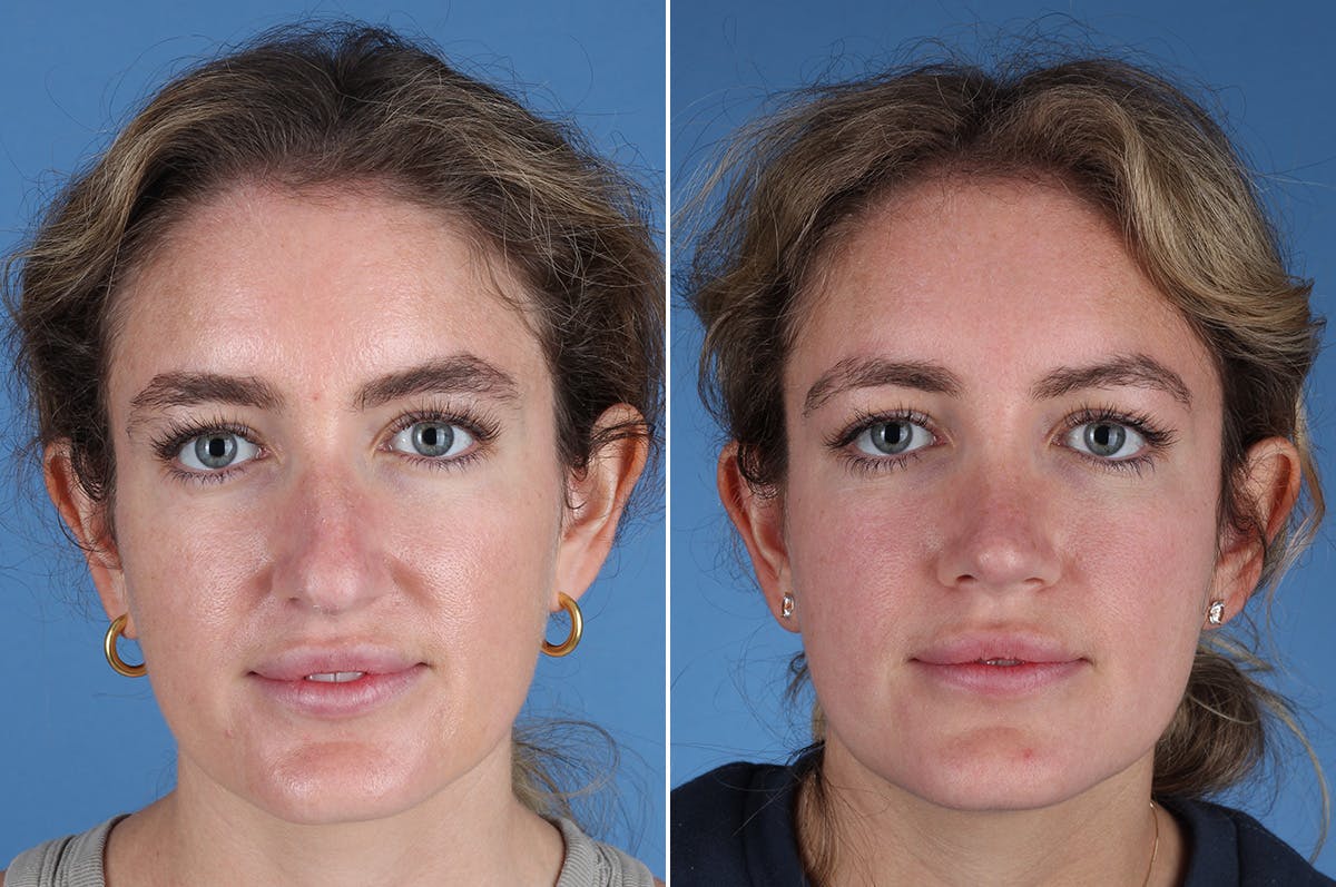 Rhinoplasty Before & After Gallery - Patient 336752 - Image 2