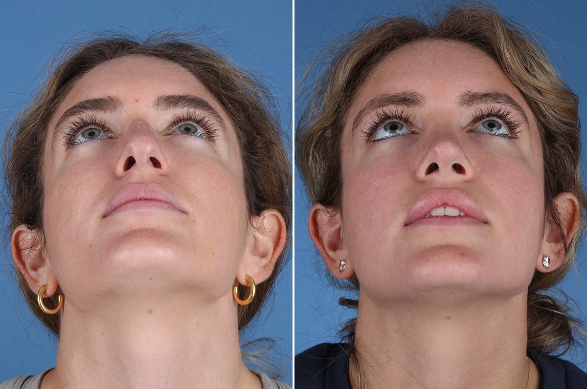 Rhinoplasty Before & After Gallery - Patient 336752 - Image 3