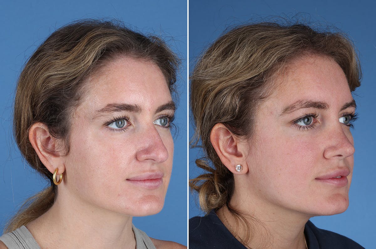 Rhinoplasty Before & After Gallery - Patient 336752 - Image 4