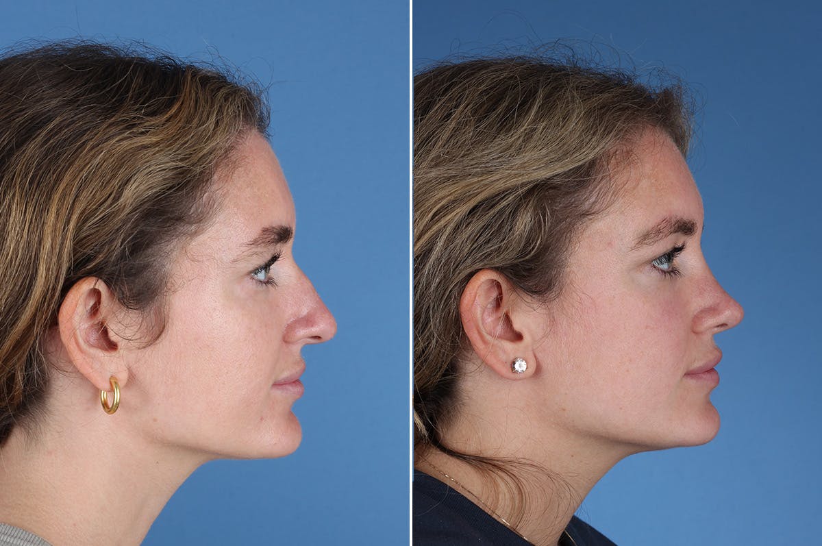 Rhinoplasty Before & After Gallery - Patient 336752 - Image 5