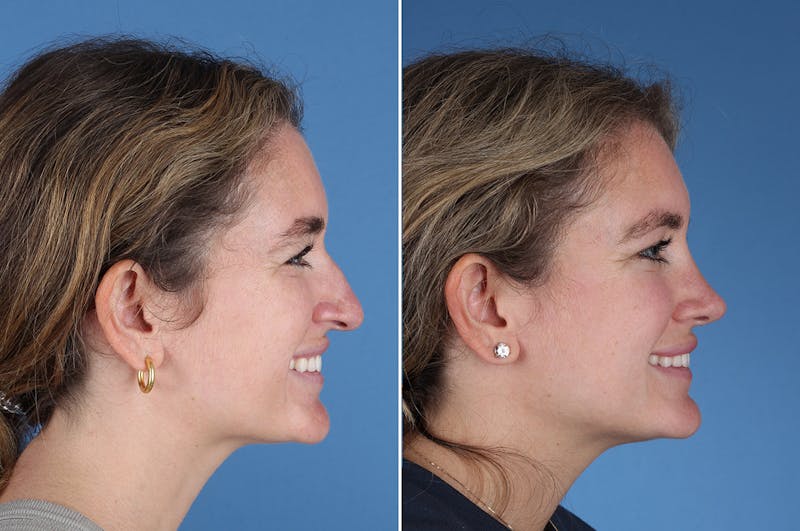 Rhinoplasty Before & After Gallery - Patient 336752 - Image 1