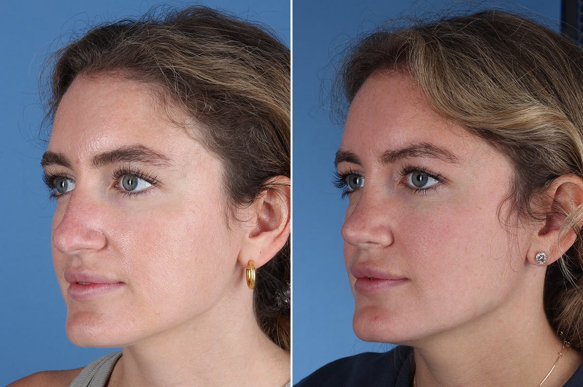 Rhinoplasty Before & After Gallery - Patient 336752 - Image 6