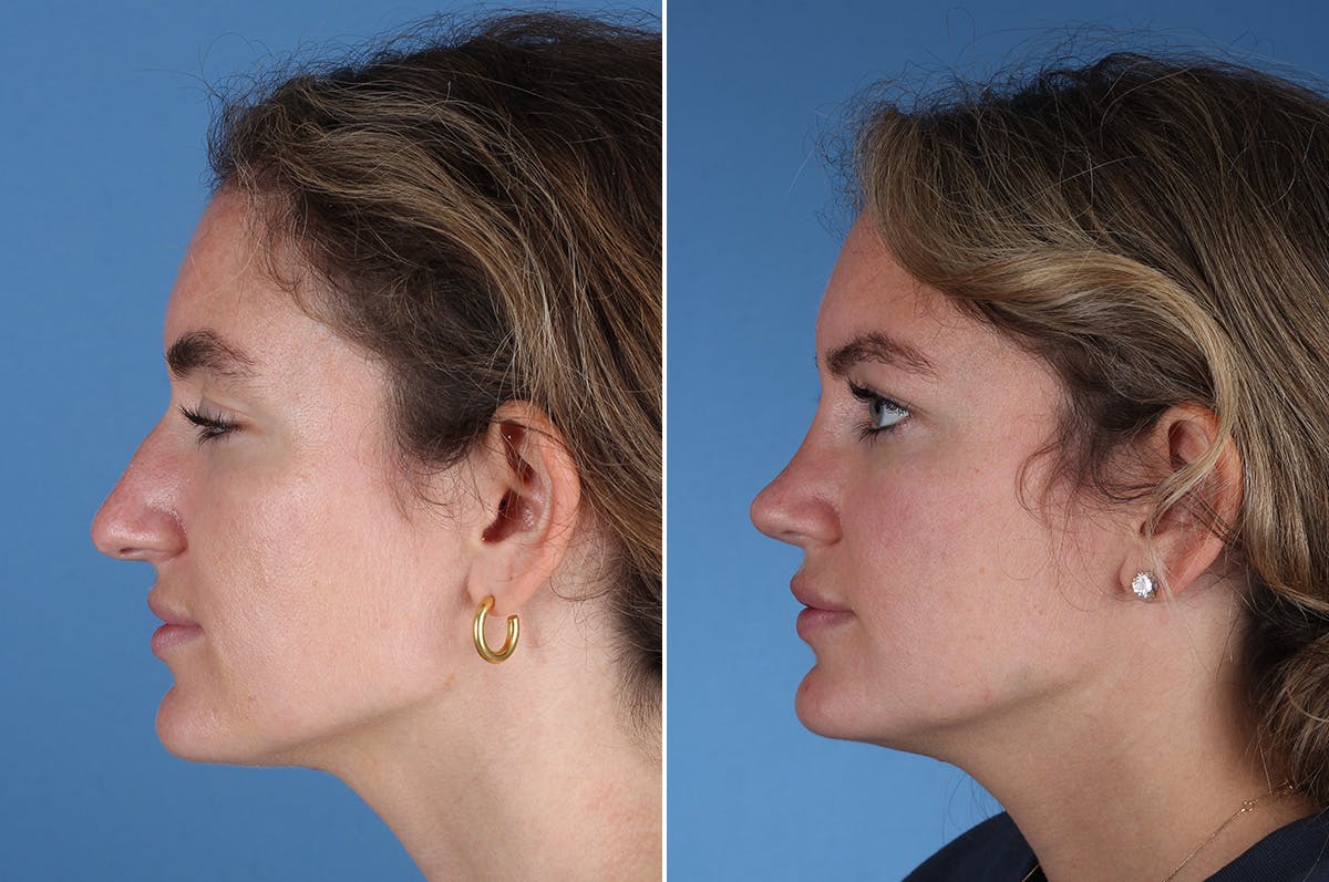 Rhinoplasty Before & After Gallery - Patient 336752 - Image 7