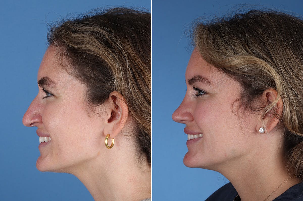 Rhinoplasty Before & After Gallery - Patient 336752 - Image 8
