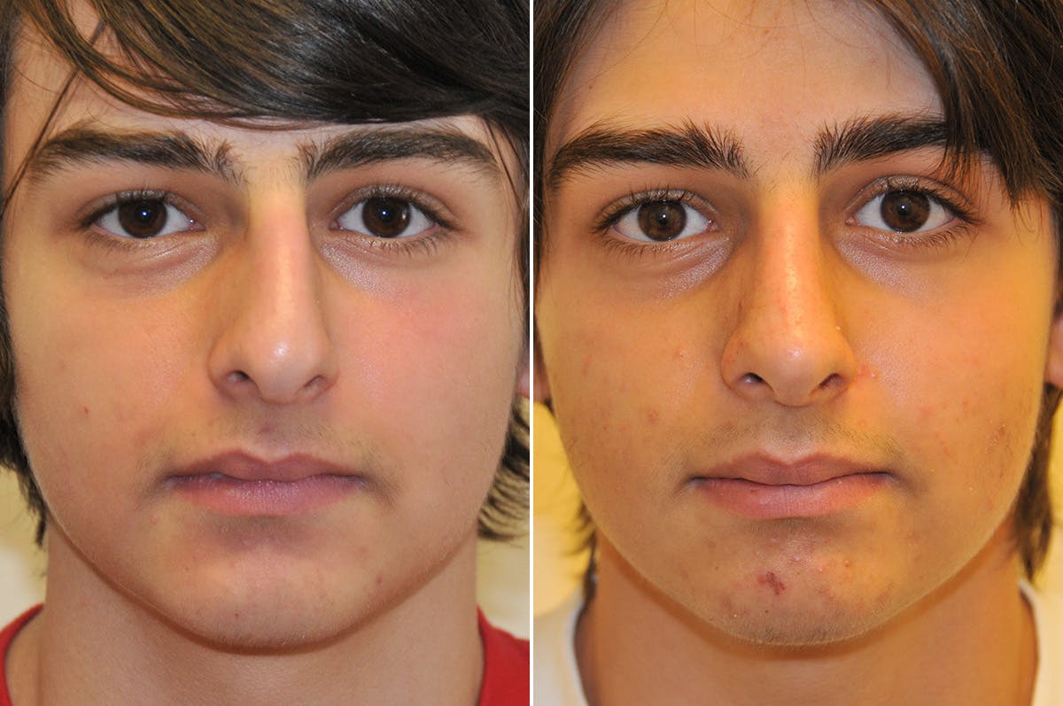 Rhinoplasty Before & After Gallery - Patient 276463 - Image 2