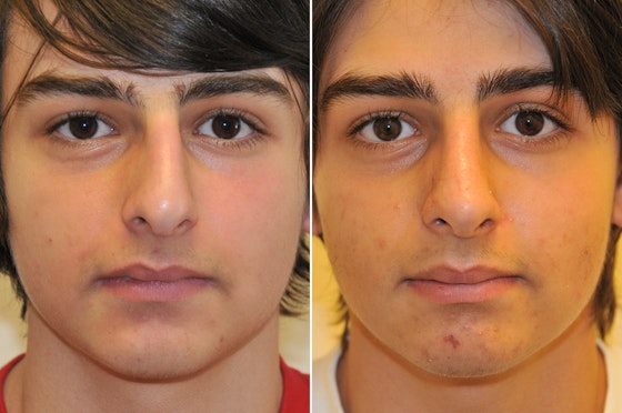 Rhinoplasty before and after — actual patient of Andre Panossian, MD