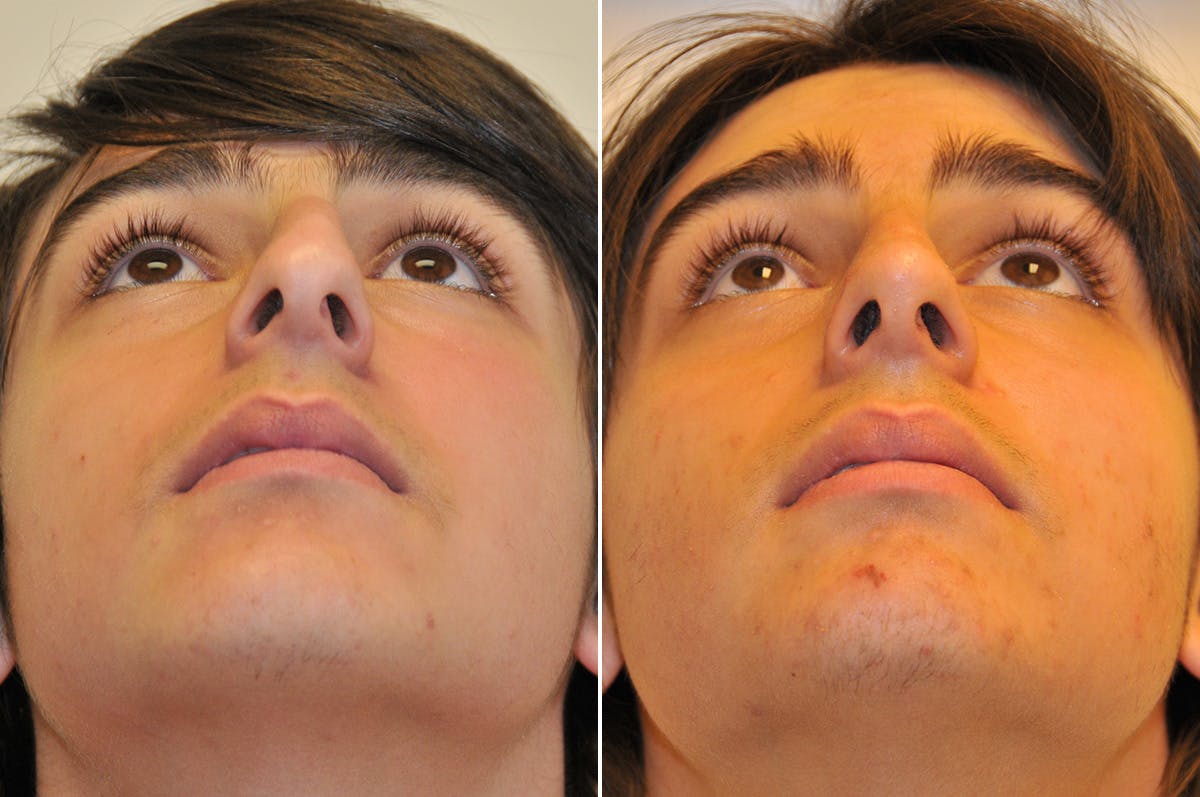 Rhinoplasty Before & After Gallery - Patient 276463 - Image 3