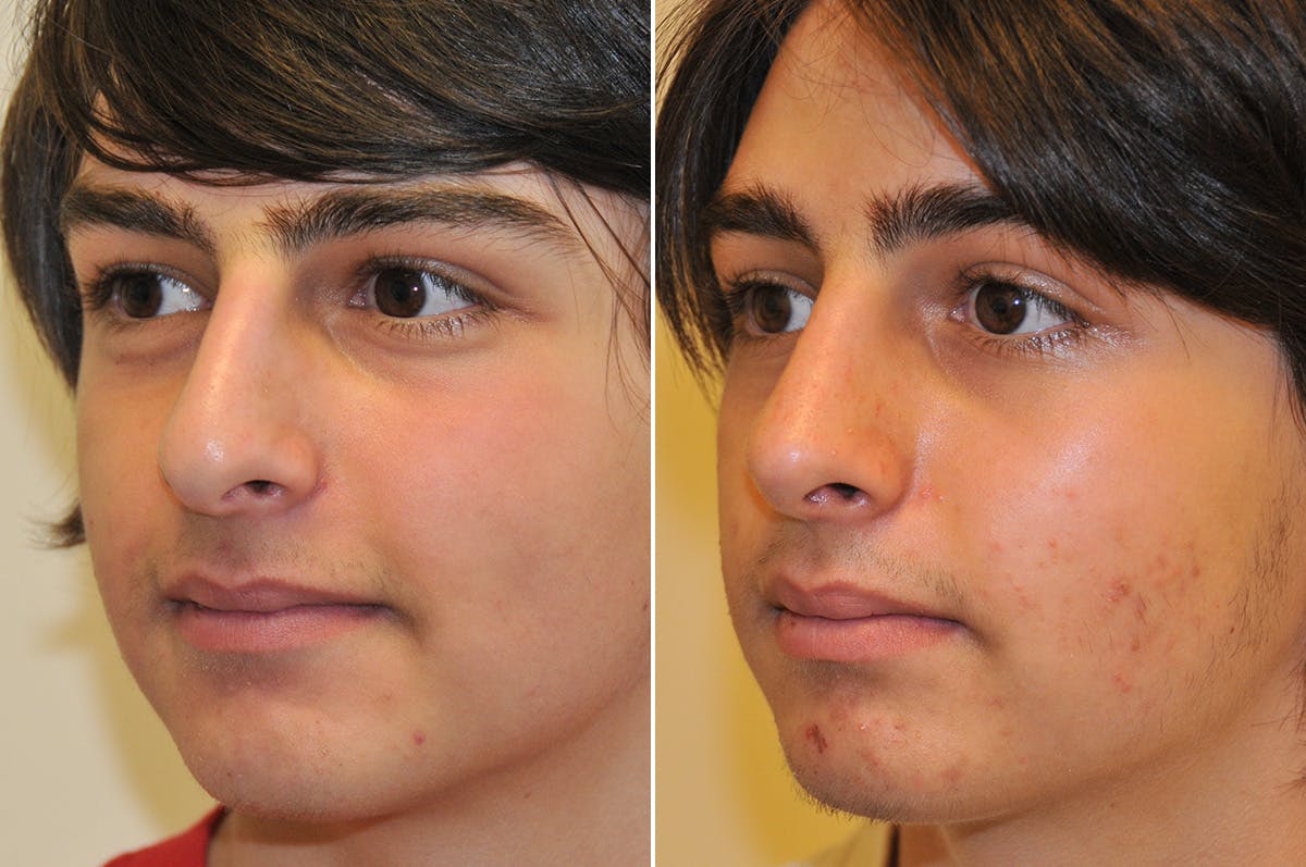 Rhinoplasty Before & After Gallery - Patient 276463 - Image 4