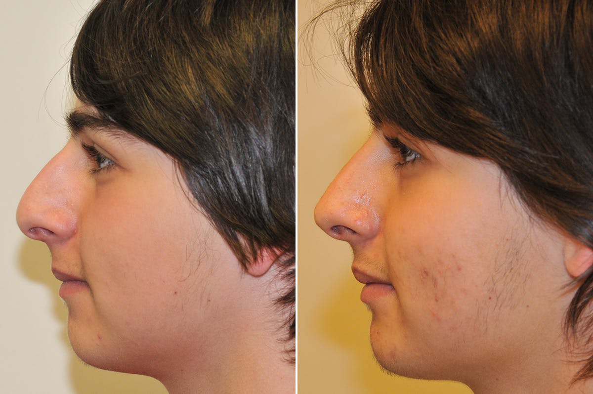 Rhinoplasty Before & After Gallery - Patient 276463 - Image 5