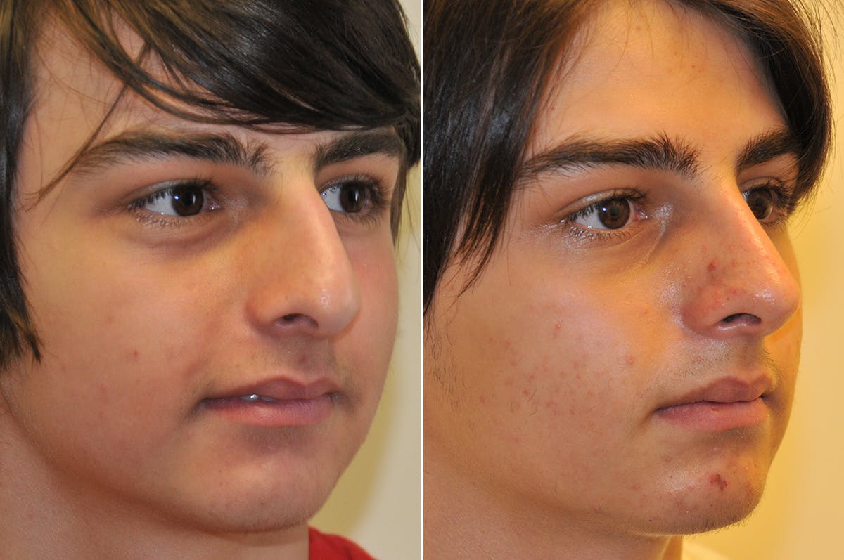 Rhinoplasty Before & After Gallery - Patient 276463 - Image 6
