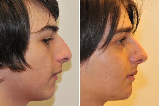 Rhinoplasty before and after — actual patient of Andre Panossian, MD