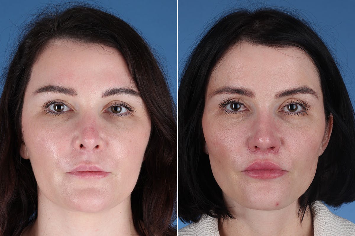 Revision Rhinoplasty Before & After Gallery - Patient 209920 - Image 2