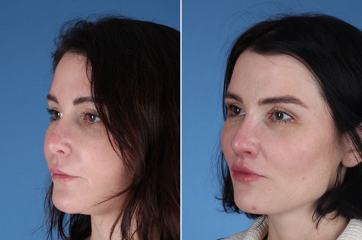 Revision Rhinoplasty Before & After Gallery - Patient 209920 - Image 3