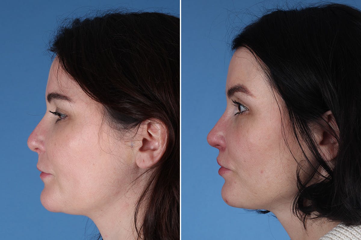 Revision Rhinoplasty Before & After Gallery - Patient 209920 - Image 4