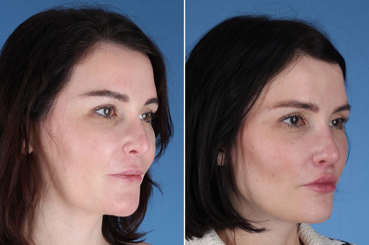 Revision Rhinoplasty Before & After Gallery - Patient 209920 - Image 6