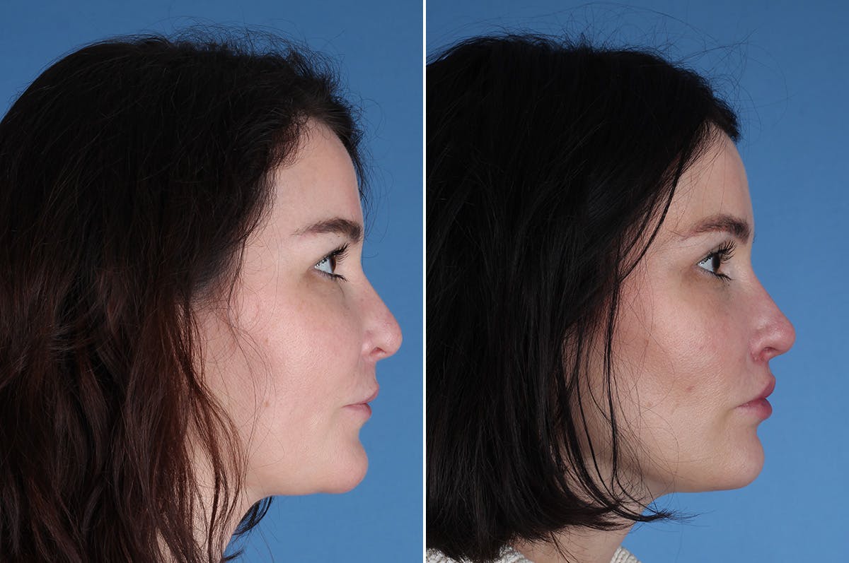 Revision Rhinoplasty Before & After Gallery - Patient 209920 - Image 7