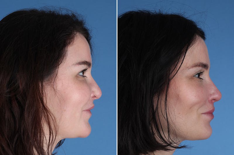 Revision Rhinoplasty Before & After Gallery - Patient 209920 - Image 1