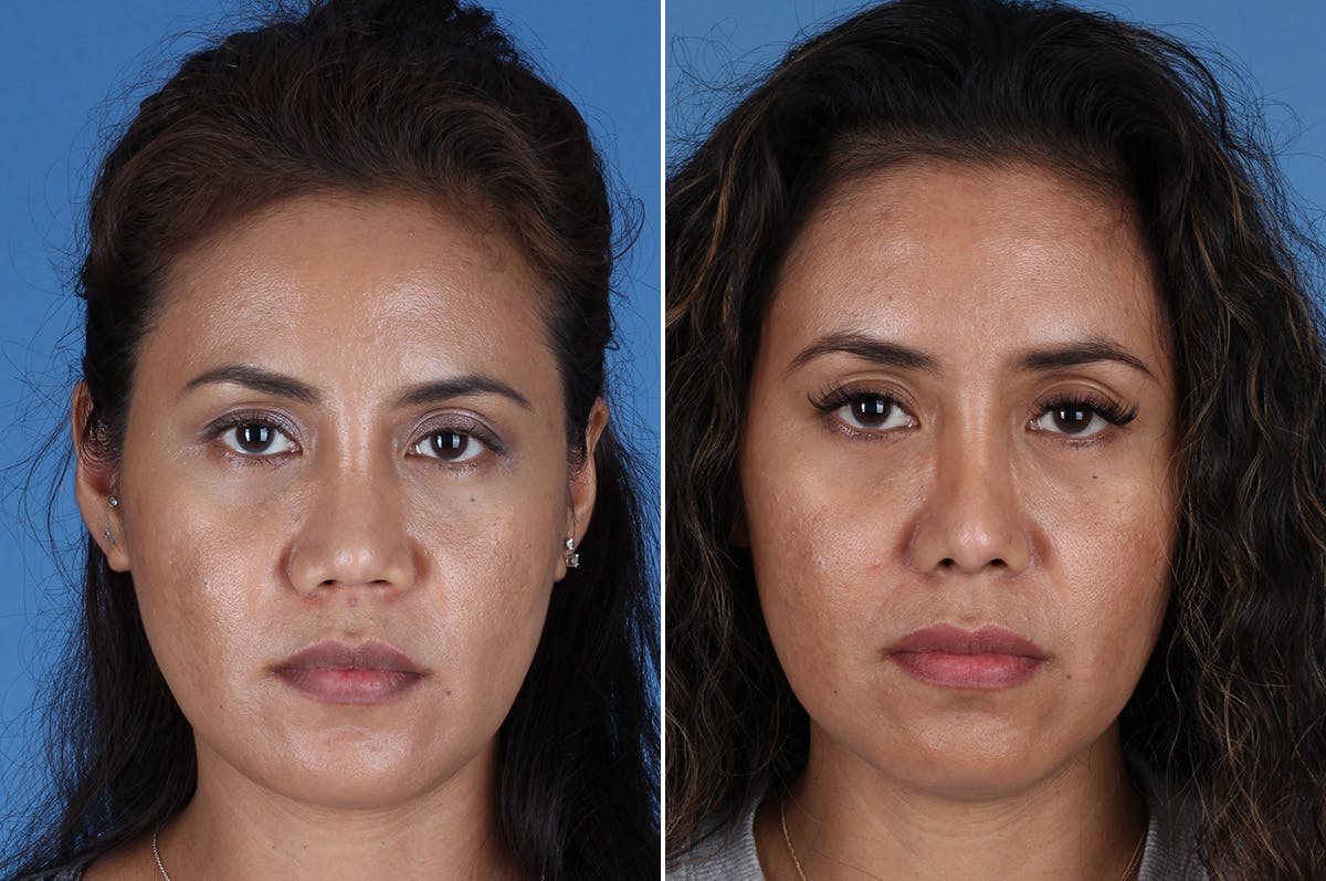 Revision Rhinoplasty Before & After Gallery - Patient 245396 - Image 2
