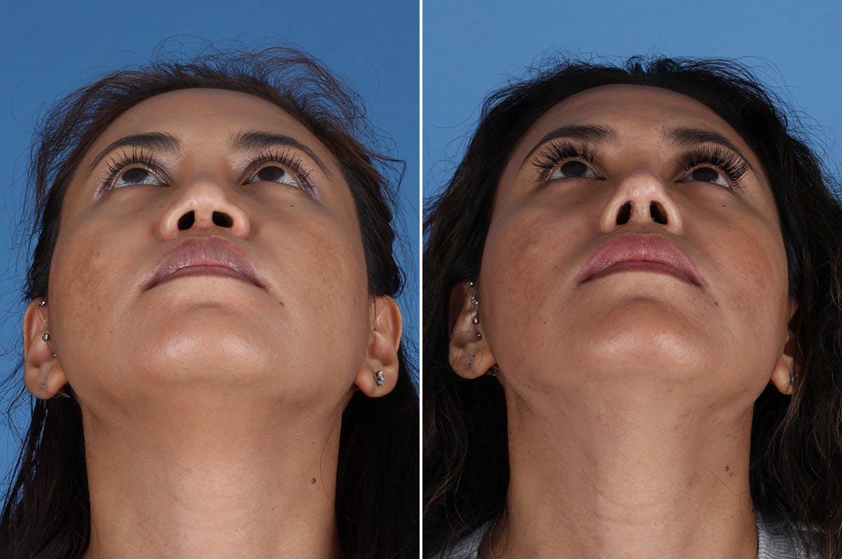 Revision Rhinoplasty Before & After Gallery - Patient 245396 - Image 3