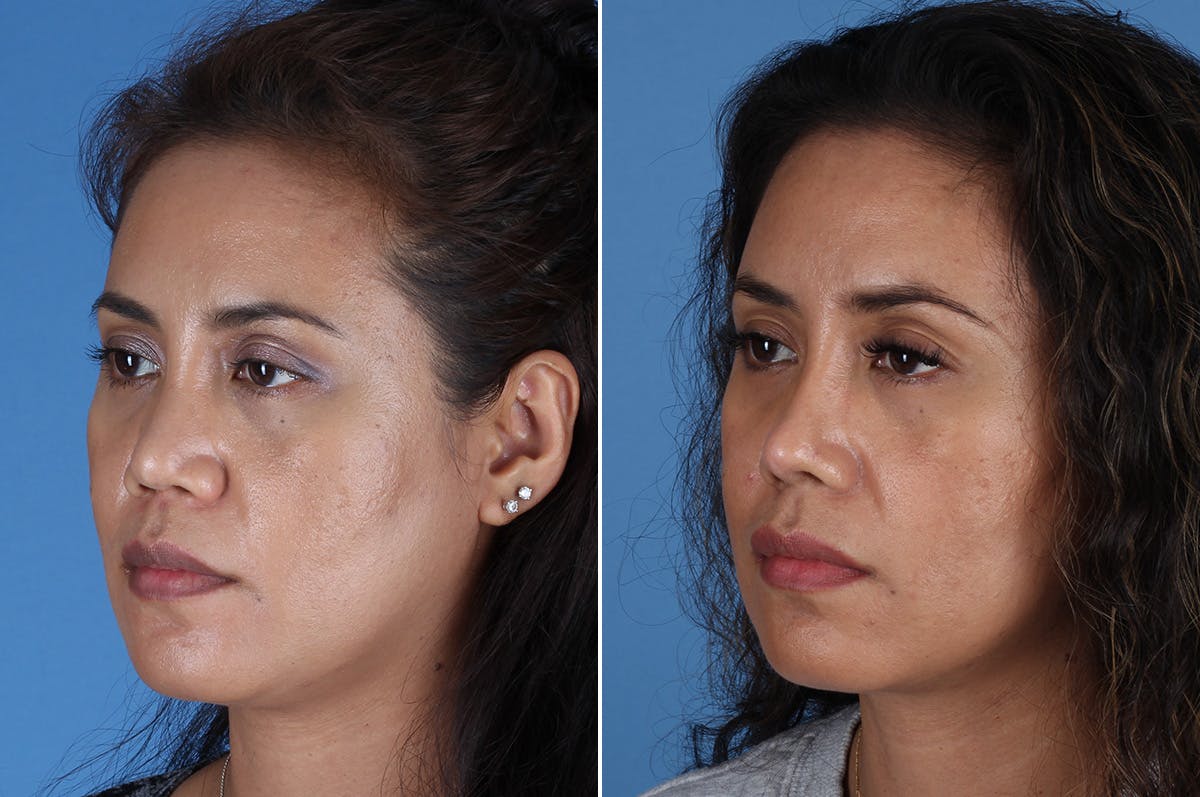 Revision Rhinoplasty Before & After Gallery - Patient 245396 - Image 4