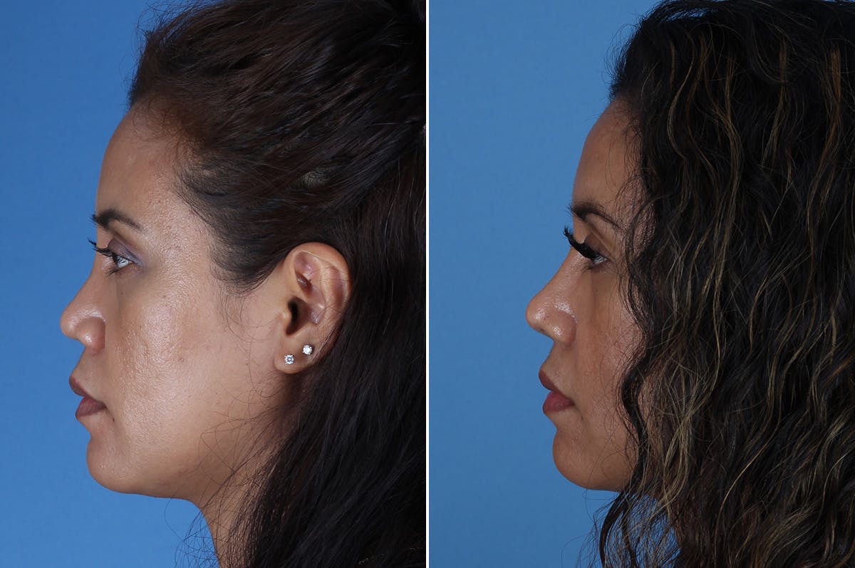 Revision Rhinoplasty Before & After Gallery - Patient 245396 - Image 5