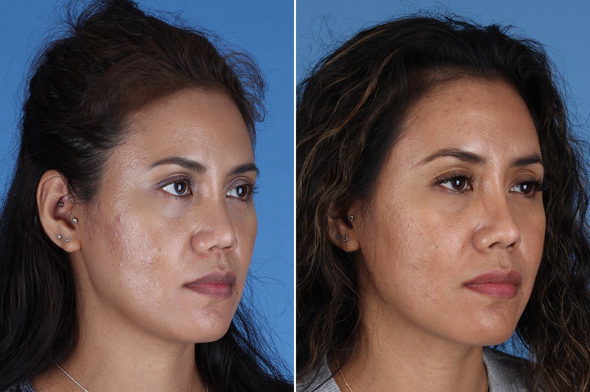 Revision Rhinoplasty Before & After Gallery - Patient 245396 - Image 6