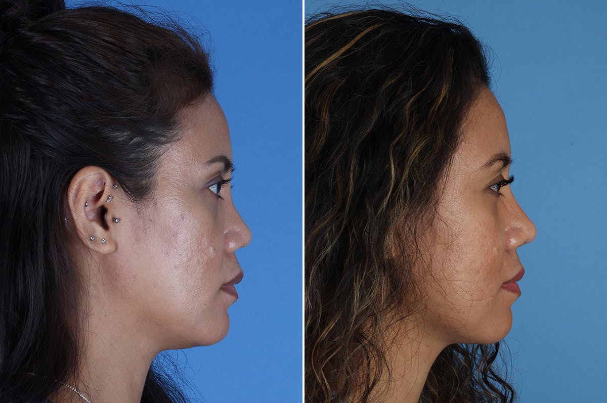 Revision Rhinoplasty Before & After Gallery - Patient 245396 - Image 1
