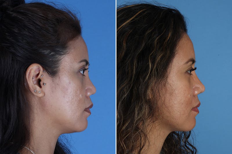 Revision Rhinoplasty Before & After Gallery - Patient 245396 - Image 1